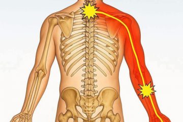 Đông y trị đau cổ vai gáy: Khai thông khí huyết bằng huyền châm cứu ngải