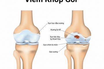 NGƯỜI CAO TUỔI TỰ CHỮA TRÀN DỊCH KHỚP GỐI BẰNG PHƯƠNG PHÁP DÂN GIAN