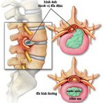 Bấm huyệt trị thoát vị đĩa đệm: 4 huyệt đạo giảm đau lưng hiệu quả