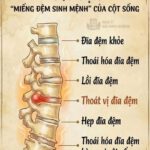 ĐĨA ĐỆM: “CHÌA KHÓA” QUYẾT ĐỊNH SỨC KHỎE CỘT SỐNG