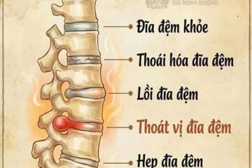 ĐĨA ĐỆM: “CHÌA KHÓA” QUYẾT ĐỊNH SỨC KHỎE CỘT SỐNG